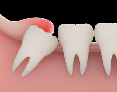 Problems With A Wisdom Tooth And When You Need To Remove Them Mooresville Dental Center